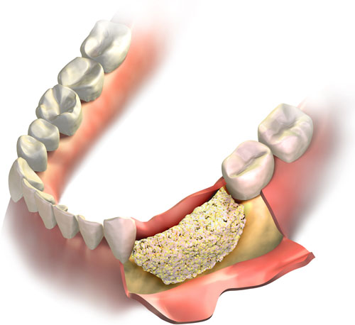 bone graft