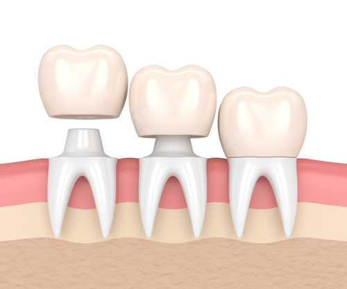 dental crowns