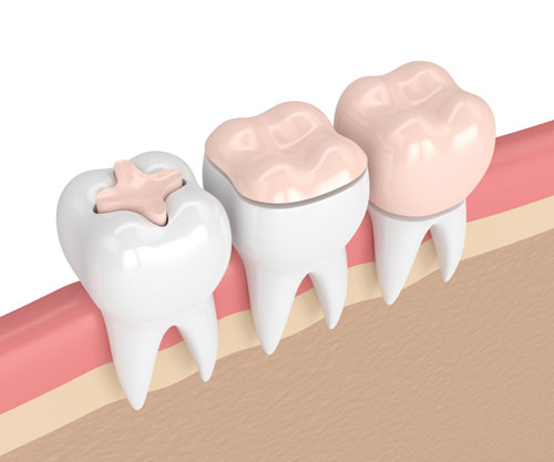 inlay restorations