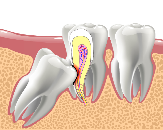 wisdom teeth extraction